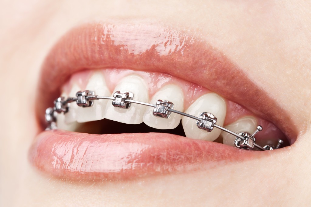 mouth of woman with braces in her teeth