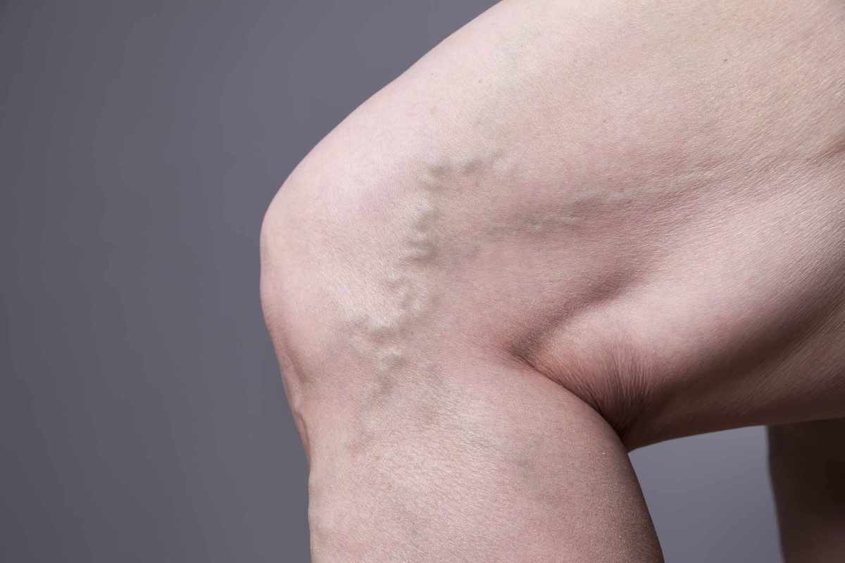 person with varicose veins